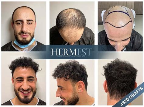 hermest hair transplant|hermest hair clinic istanbul.